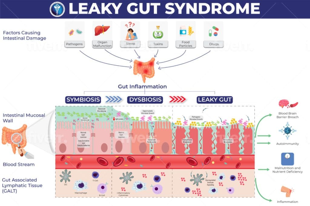 leaky gut